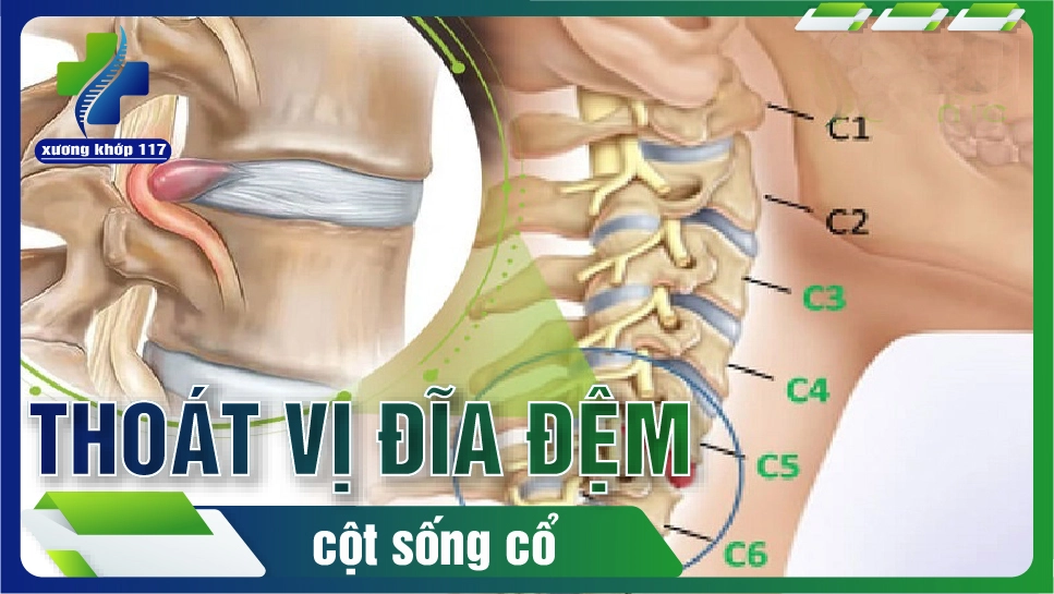 chuyên gia căn chỉnh cột sống trên đệm Dreamland